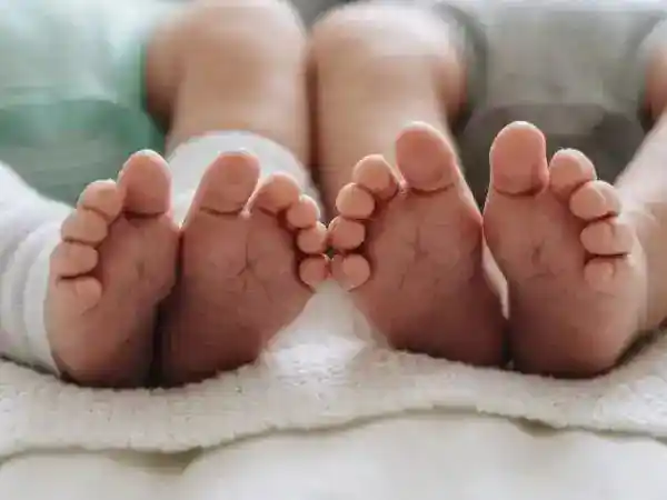 Perkembangan Pemulihan Bayi Kembar Siam Usai Operasi Pemisahan di RSCM
